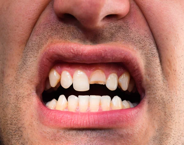Зламаний Зуб Зламаний Верхній Різник Роті Людини Чоловік Показує Порожнину — стокове фото