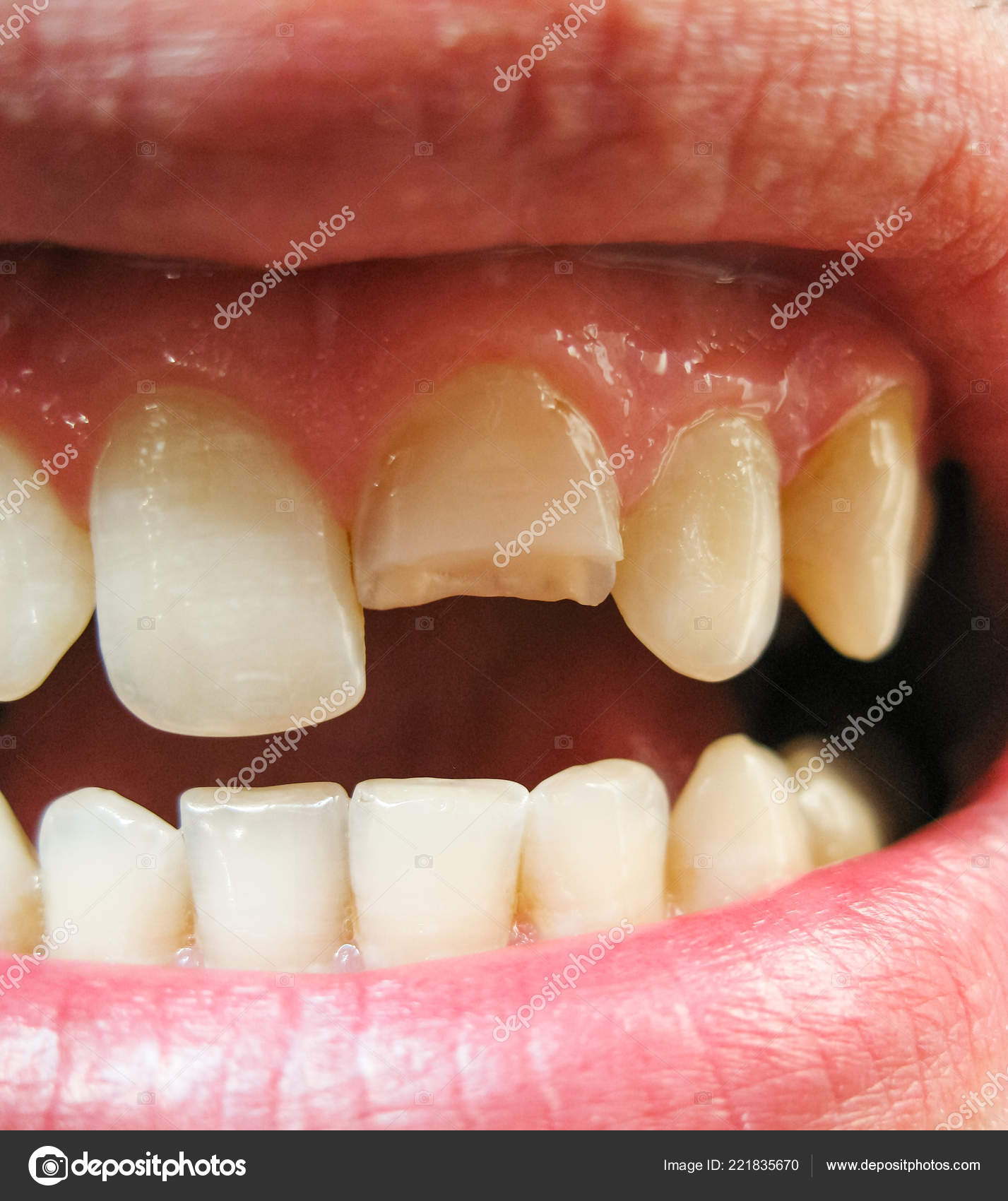 Une Dent Cassée Incisive Supérieure Cassée Dans Bouche D