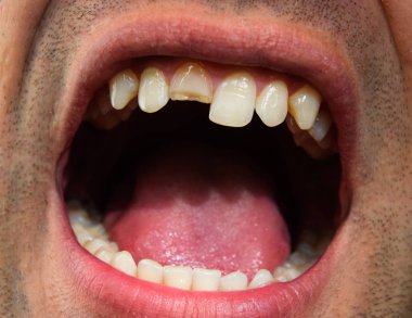 Kırık diş. Üst kesici bir adam ağzına kırık. Adam ağız boşluğu dişçiye gösterir. Kırık bir diş tedavisi.