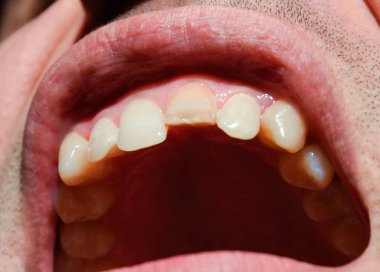 Kırık diş. Üst kesici bir adam ağzına kırık. Adam ağız boşluğu dişçiye gösterir. Kırık bir diş tedavisi.