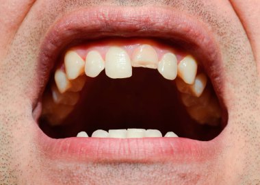 Kırık diş. Üst kesici bir adam ağzına kırık. Adam ağız boşluğu dişçiye gösterir. Kırık bir diş tedavisi.