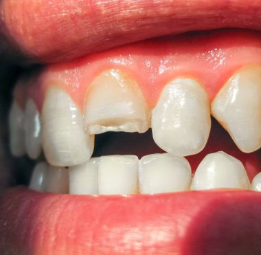 Kırık diş. Üst kesici bir adam ağzına kırık. Adam ağız boşluğu dişçiye gösterir. Kırık bir diş tedavisi.