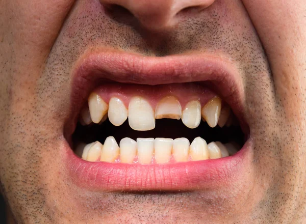 Broken tooth. Broken upper incisor in a man mouth. Man shows oral cavity to the dentist. Treatment of a broken tooth.