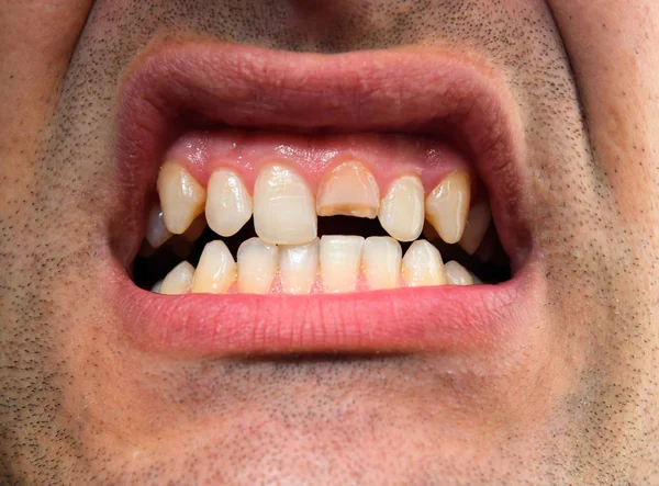 折れた歯 男の口の上顎切歯を壊れた 歯医者に口腔内を示しています 折れた歯の治療 — ストック写真