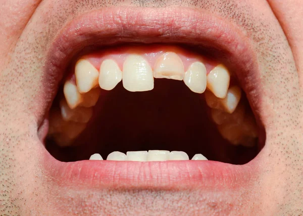 Zlomený Zub Nefunkční Horní Řezák Ústech Muže Muž Ukazuje Zubaři — Stock fotografie