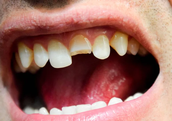 Gebroken Tand Gebroken Bovenste Snijtand Mond Van Een Mens Man — Stockfoto