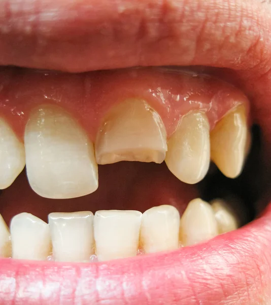 Złamany Ząb Podziale Górnych Siekaczy Ustach Człowieka Człowiek Pokazuje Jamy — Zdjęcie stockowe