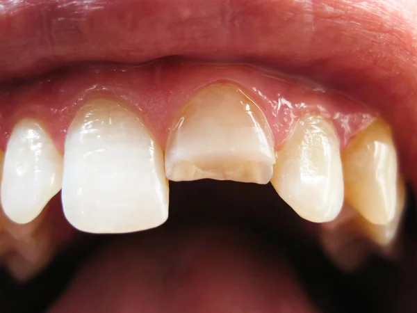 Σπασμένο Δόντι Σπασμένα Άνω Κοπτήρα Στο Στόμα Ενός Ανθρώπου Άνθρωπος — Φωτογραφία Αρχείου