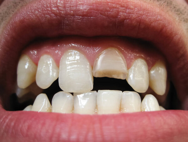 Сломанный зуб. Сломанный верхний резец во рту мужчины. Человек показывает стоматологу полость рта. Лечение сломанного зуба
.