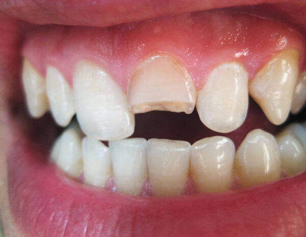 Broken tooth. Broken upper incisor in a man mouth. Man shows oral cavity to the dentist. Treatment of a broken tooth.