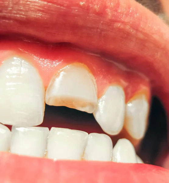 Złamany Ząb Podziale Górnych Siekaczy Ustach Człowieka Człowiek Pokazuje Jamy — Zdjęcie stockowe