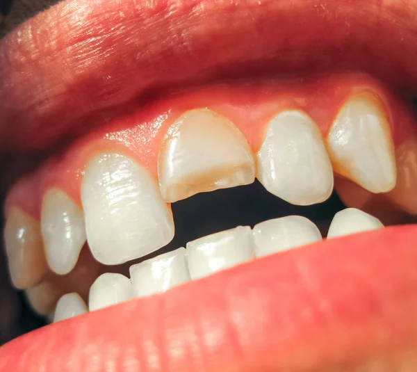 折れた歯 男の口の上顎切歯を壊れた 歯医者に口腔内を示しています 折れた歯の治療 — ストック写真