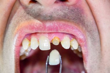 Cımbız metal seramik diş protez. Bir diş olmadan bir hasta protez üzerinde çalışıyor. Diş implantasyonu, diş tedavisi.