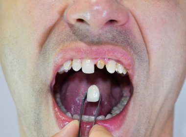 Cımbız metal seramik diş protez. Bir diş olmadan bir hasta protez üzerinde çalışıyor. Diş implantasyonu, diş tedavisi.