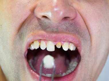 Cımbız metal seramik diş protez. Bir diş olmadan bir hasta protez üzerinde çalışıyor. Diş implantasyonu, diş tedavisi.
