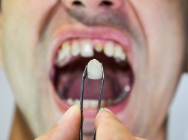 Dental prosthesis of metal ceramics in tweezers. A patient without a tooth is trying on a denture. Tooth implantation, dental treatment. clipart