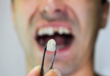 Cımbız metal seramik diş protez. Bir diş olmadan bir hasta protez üzerinde çalışıyor. Diş implantasyonu, diş tedavisi.
