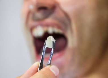 Dental prosthesis of metal ceramics in tweezers. A patient without a tooth is trying on a denture. Tooth implantation, dental treatment. clipart