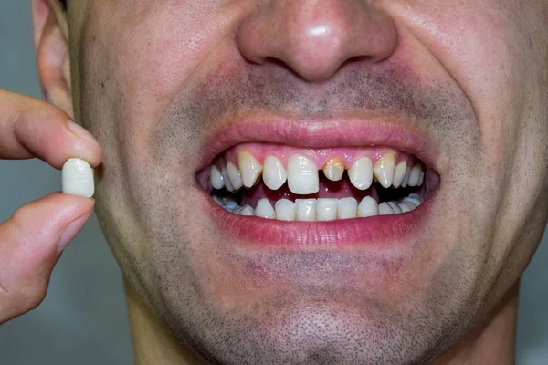 Dental prosthesis of metal ceramics in the hand of a man without a tooth. A patient without a tooth is trying on a denture. Tooth implantation, dental treatment.