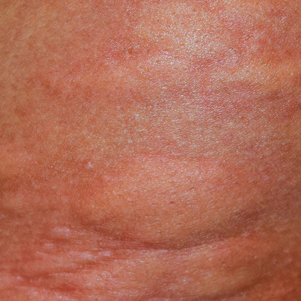Allergi Huden Tillbaka Och Sidor Allergiska Reaktioner Huden Form Svullnad — Stockfoto