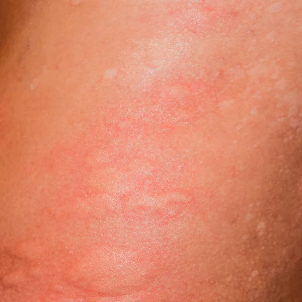 Allergy Skin Back Sides Allergic Reactions Skin Form Swelling Redness — Stock Photo, Image