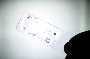 Tümör cam altında dilim. Kanser varlığı için tümör hücrelerinin histolojik inceleme
