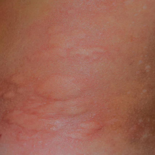Αλλεργία δέρμα πίσω και τις πλευρές. Αλλεργικές αντιδράσεις στο δέρμα με τη μορφή οίδημα και ερυθρότητα — Φωτογραφία Αρχείου