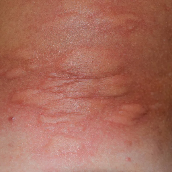 Allergy skin back and sides. Allergic reactions on the skin in the form of swelling and redness — Stock Photo, Image