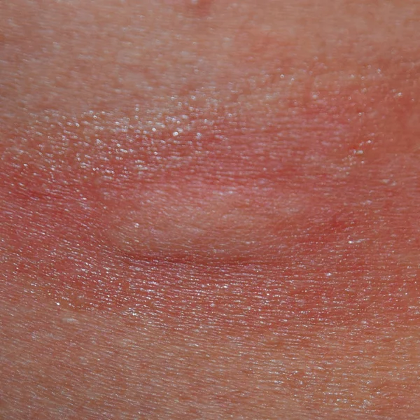 Piel alérgica. Reacciones alérgicas en la piel en forma de hinchazón y enrojecimiento —  Fotos de Stock