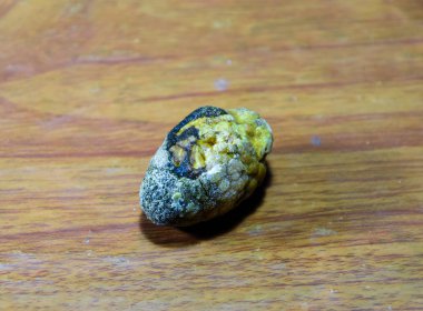 Büyük safra taşı, safra kesesi taşı. Safra taşlarının sonucu