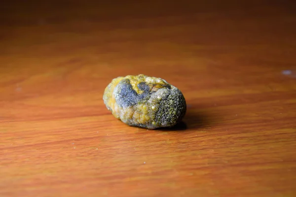 Pedra biliar grande, pedra da vesícula biliar. O resultado de cálculos biliares — Fotografia de Stock