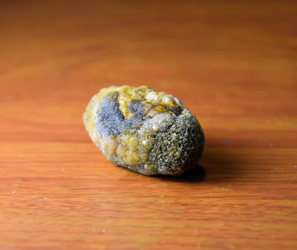 Büyük safra taşı, safra kesesi taşı. Safra taşlarının sonucu