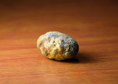 Büyük safra taşı, safra kesesi taşı. Safra taşlarının sonucu