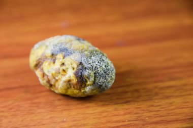 Büyük safra taşı, safra kesesi taşı. Safra taşlarının sonucu