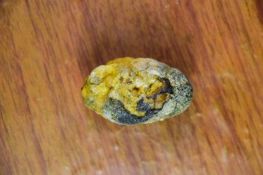 Büyük safra taşı, safra kesesi taşı. Safra taşlarının sonucu