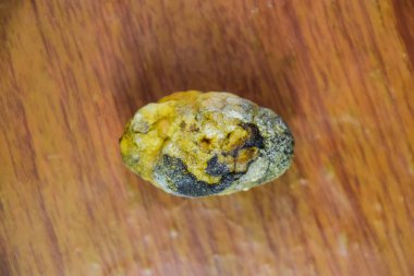 Büyük safra taşı, safra kesesi taşı. Safra taşlarının sonucu