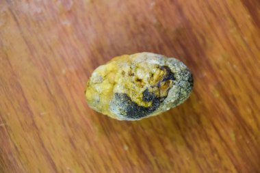 Büyük safra taşı, safra kesesi taşı. Safra taşlarının sonucu