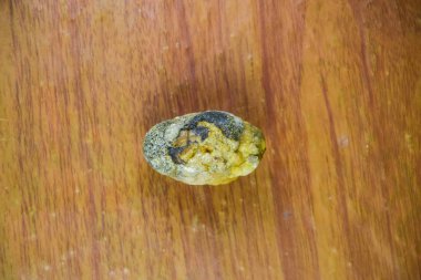 Büyük safra taşı, safra kesesi taşı. Safra taşlarının sonucu