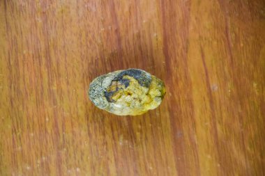 Büyük safra taşı, safra kesesi taşı. Safra taşlarının sonucu