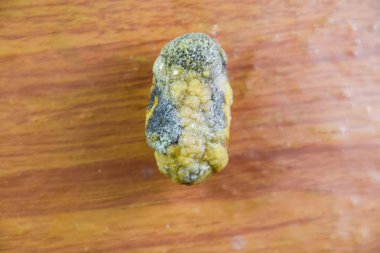 Büyük safra taşı, safra kesesi taşı. Safra taşlarının sonucu