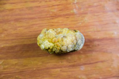 Büyük safra taşı, safra kesesi taşı. Safra taşlarının sonucu