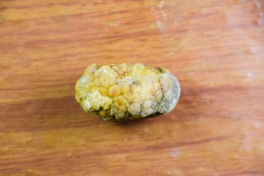 Büyük safra taşı, safra kesesi taşı. Safra taşlarının sonucu