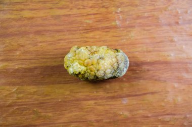 Büyük safra taşı, safra kesesi taşı. Safra taşlarının sonucu