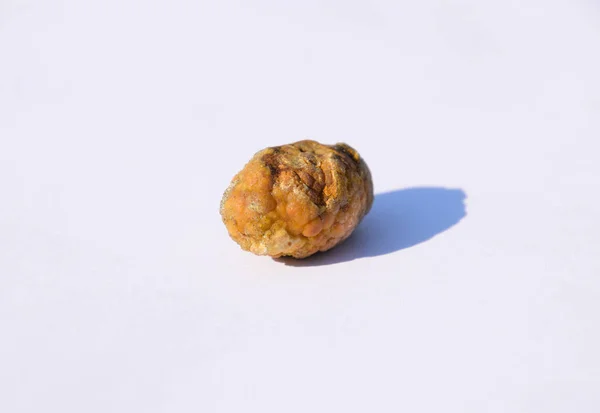 胆嚢の石。胆石の結果。不均一な組成物の微積分. — ストック写真