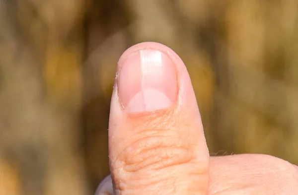 Clavo bifurcado en el pulgar. Dilatación de las uñas, patología traumática. El clavo se divide por la mitad —  Fotos de Stock