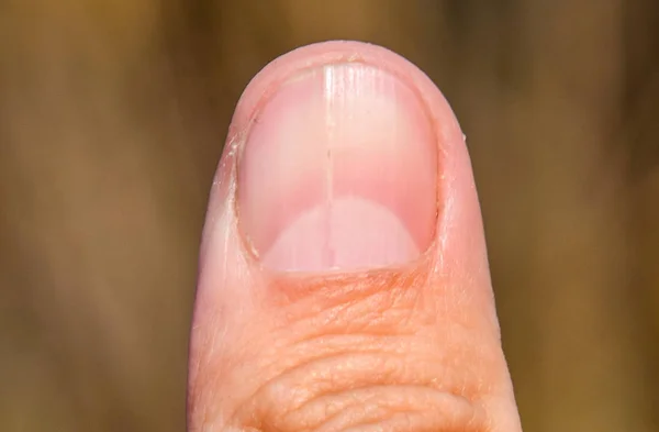 Clavo bifurcado en el pulgar. Dilatación de las uñas, patología traumática. El clavo se divide por la mitad —  Fotos de Stock