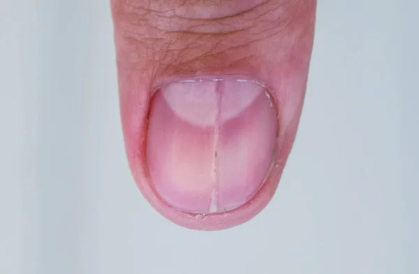 Ongle fourchu sur le pouce. Dilatation de l'ongle, pathologie traumatique. L'ongle est divisé en deux — Photo