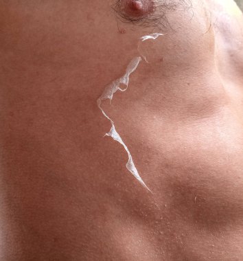 cilt üzerinde güneş yanığı etkileri. Tırmanma cilt.