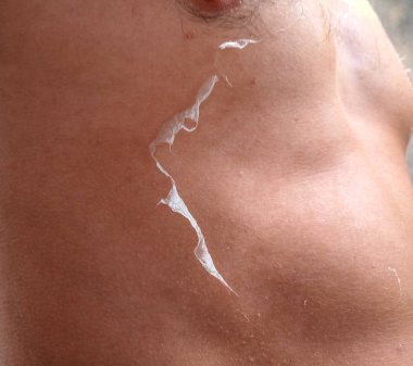 cilt üzerinde güneş yanığı etkileri. Tırmanma cilt.