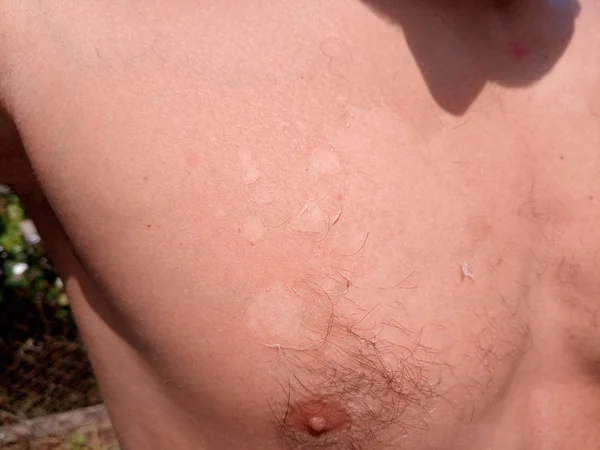 Auswirkungen von Sonnenbrand auf die Haut. Kletterhaut. — Stockfoto